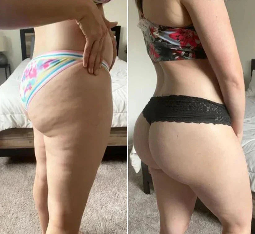 With losing and gaining weight over the years, my legs started to get a lot of cellulite marks and my butt started to sag. I decided to try MiaBody to help me and see my results. My buttocks looks rounder and firmer. Marks are less visible than before. I would recommend this device to anyone I know.